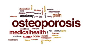 How Exercise can Help Osteoporosis from the Point of View of Exercise Physiology | StudioXPhys Physio Hope Island, Mudgeeraba