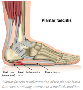 How Plantar Fasciitis Develops | StudioXPhys Physio Hope Island, Mudgeeraba