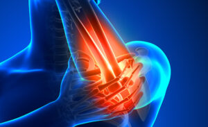 Tennis-Elbow | StudioXPhys Physio Hope Island, Mudgeeraba