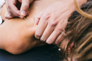 Benefits of Dry Needling | StudioXPhys Physio Hope Island, Mudgeeraba