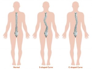 How to Treat Scoliosis | StudioXPhys Physio Hope Island, Mudgeeraba