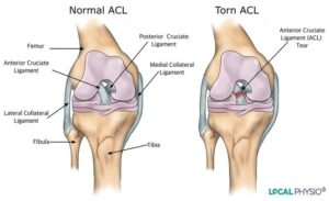 Anterior Cruciate Ligament Rupture | StudioXPhys Physio Hope Island, Mudgeeraba